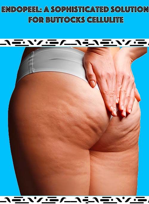 buttocks cellulite