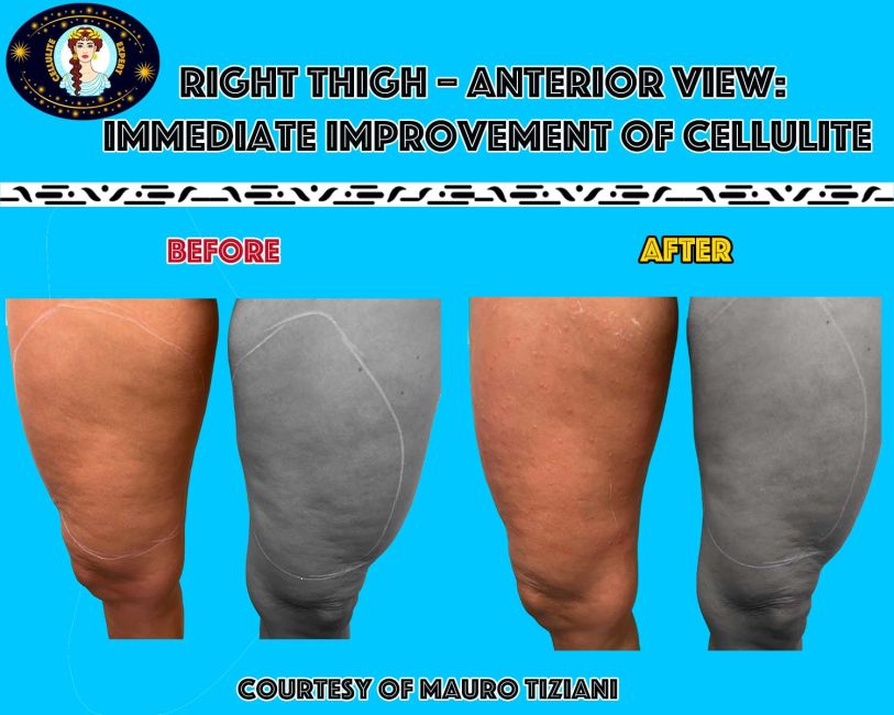 cellulite-olga-D0