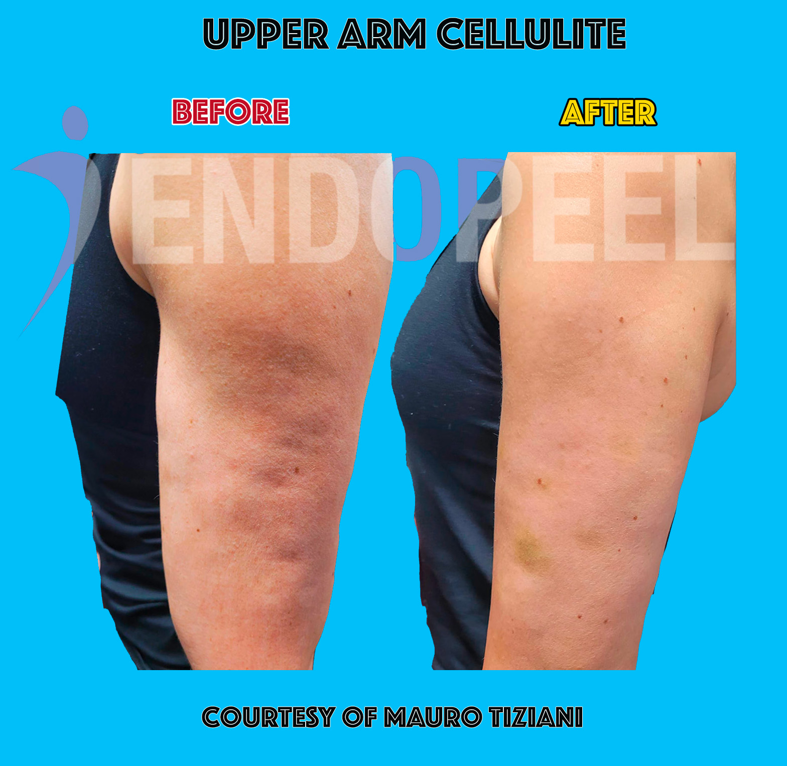 endopeel-arm-cellulite