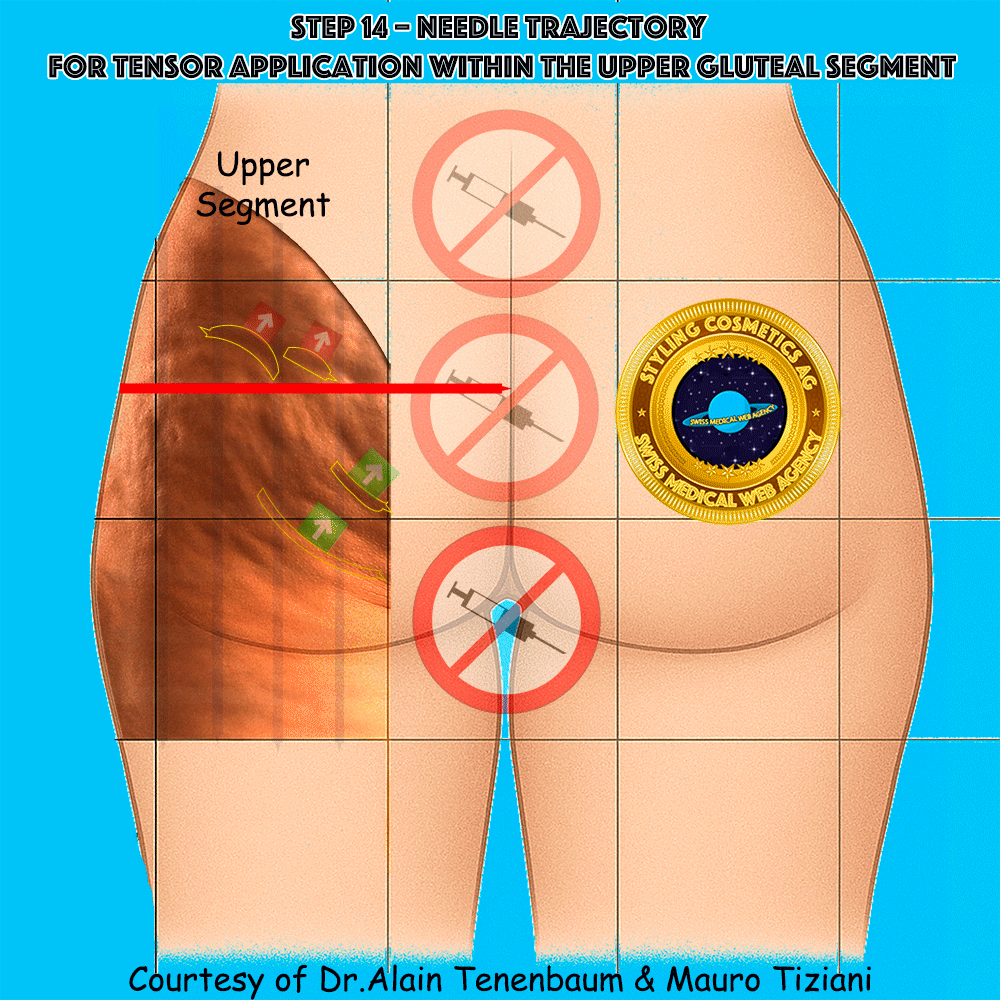 gluteal-techniques/step14.