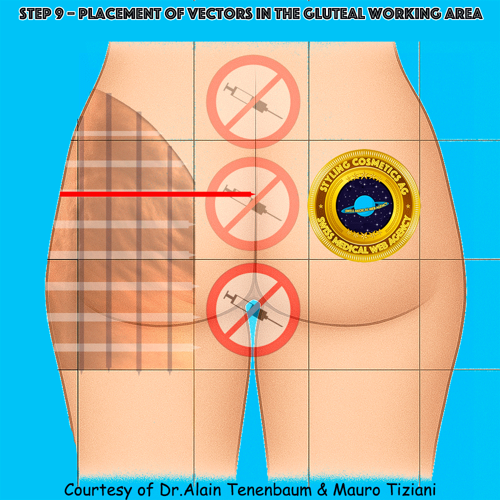 gluteal-techniques/step9.gif