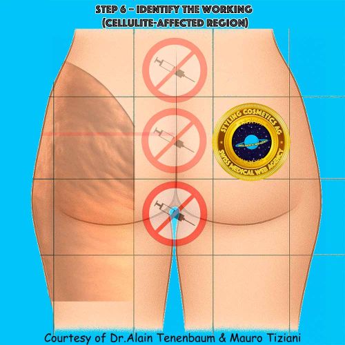identify the working cellulite affected region