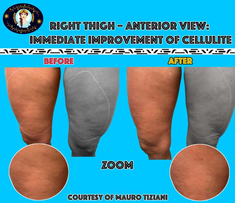 cellulite-olga-zoom