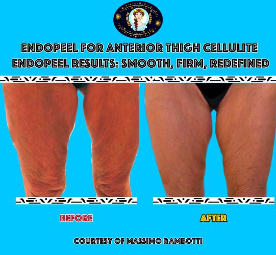 endopeel results for anterior thigh cellulite