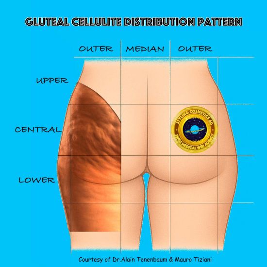 gluteal-cellulite-distribution